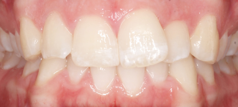 Before photo of a patient's teeth prior to orthodontic treatment.