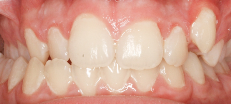 Before photo of a patient's teeth prior to orthodontic treatment.