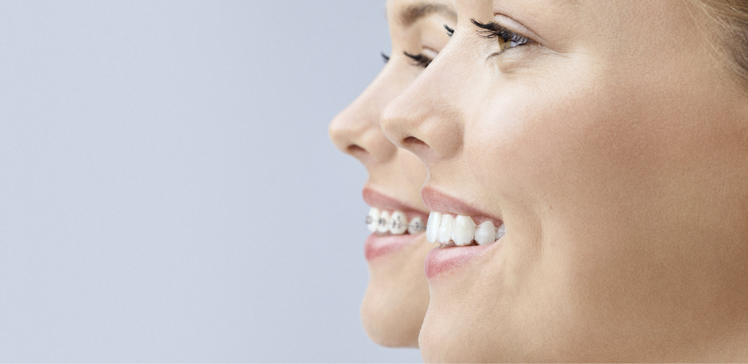 Two girsl in side view wearing invisalign